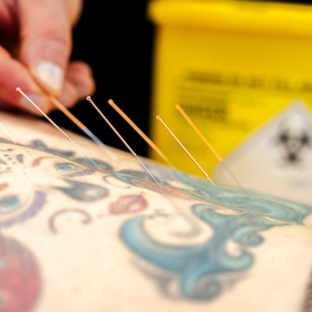 Medical Acupuncture Medical Acupuncture