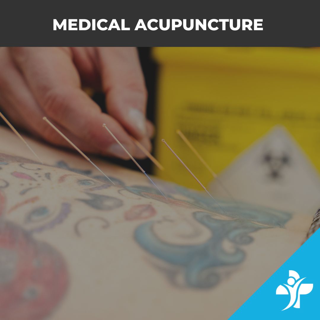Medical Acupuncture Image