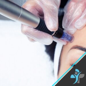 Microneedling